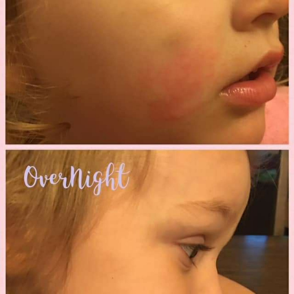 PREORDER ONLY ByeBye Stretch Marks,Mosquitos,Burns - Picture 15 of 16